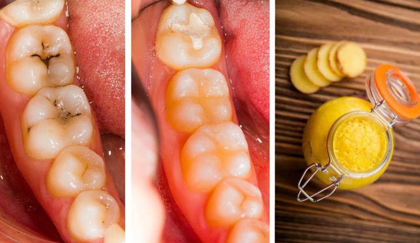 heal-cavities-and-tooth-decay-naturally