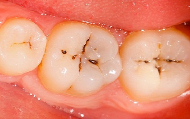 These 7 Home Remedies Will Solve Your Tooth Decaying and