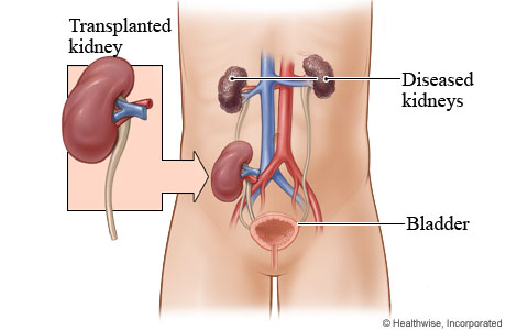 kidney-transplant