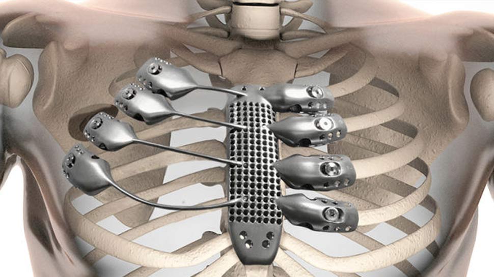 3d-printed-ribs-header