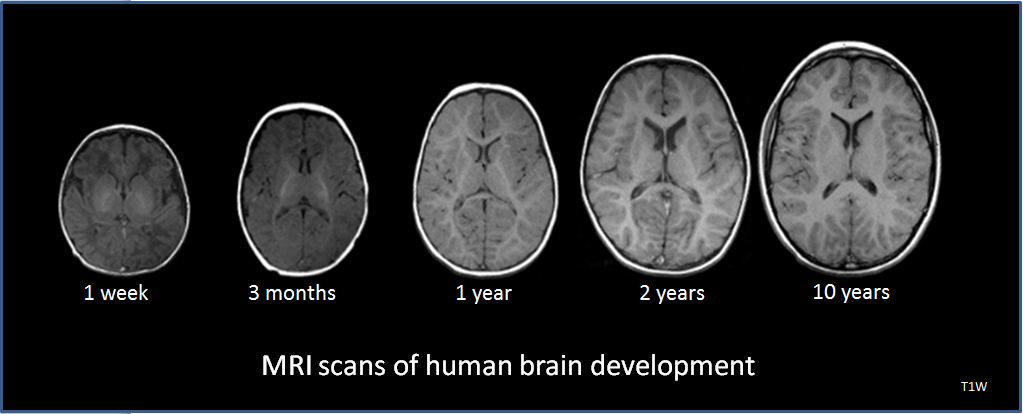 Human_brain_development_1wk-3mo-1yr-2yr-10yr-T1W-MRI