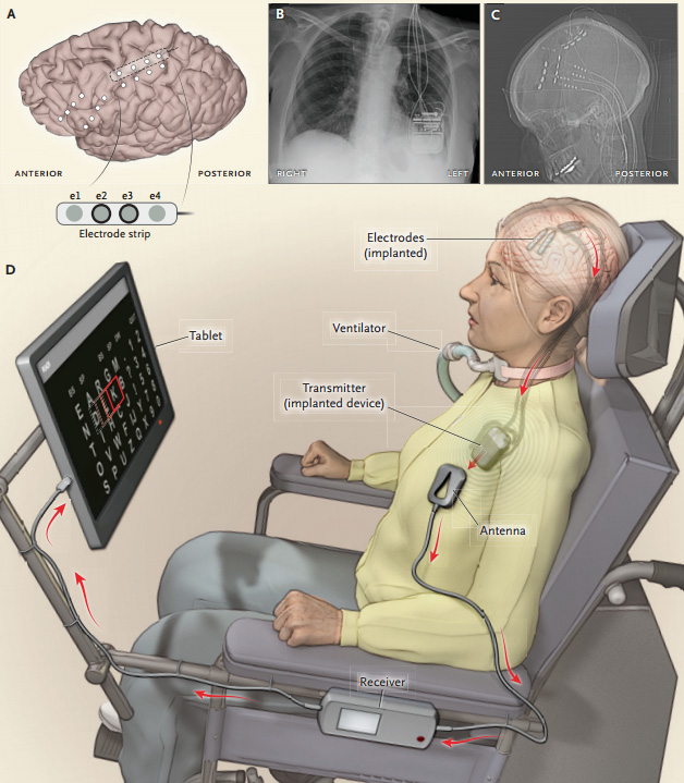 brain-implant-placement-diagram