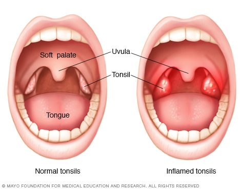 Tonsil